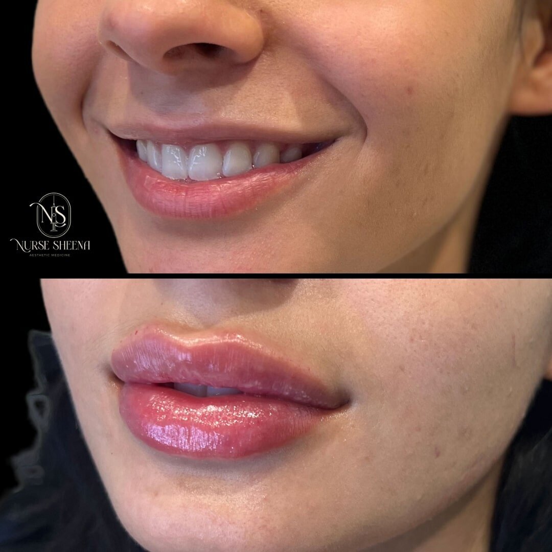 Lip Filler Results by Nurse Sheena