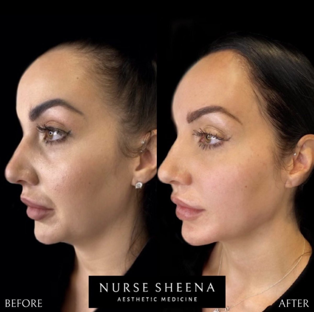 Edmonton Full Face Injections Clients Results by Nurse Sheena