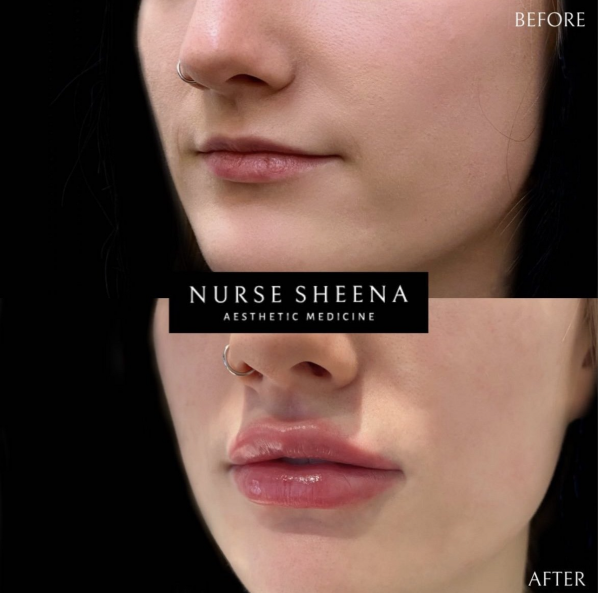 Lip Filler Results 5 by Nurse Sheena