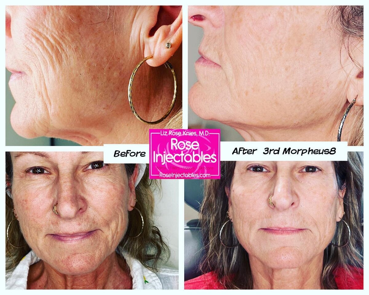 Before and after photos showing tighter and smoother skin after using Morpheus8 at Rose Injectables