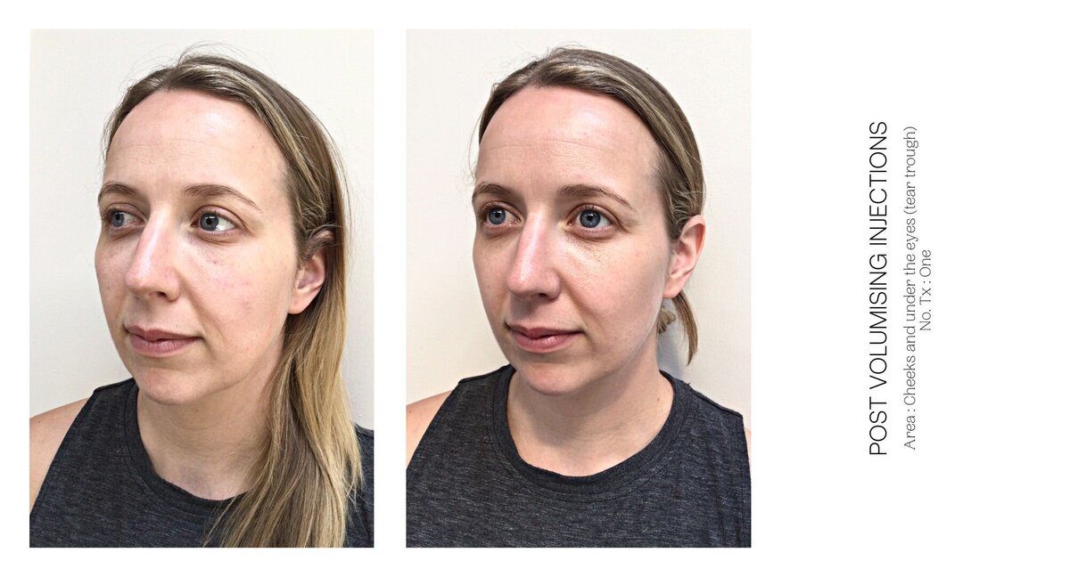 Cheek Injectable Before and After 5