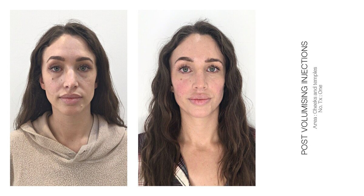 Temple Injectable Before and After 1