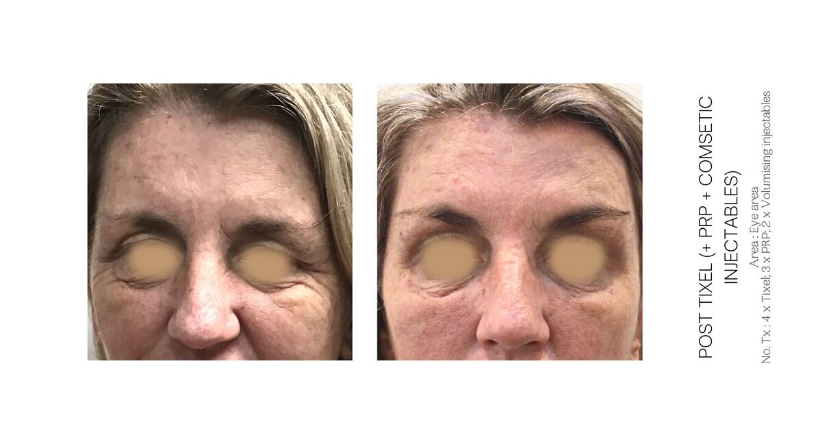 PRP and Tixel Under Eye Before and After 4