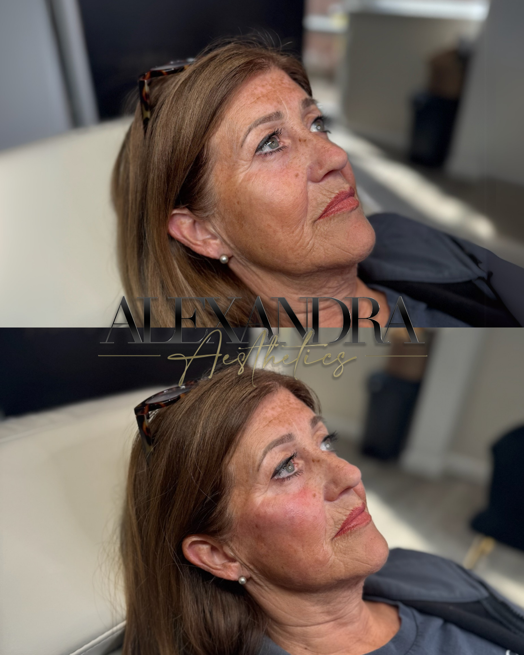 Aesthetic consultation at Alexandra Aesthetics Exeter.