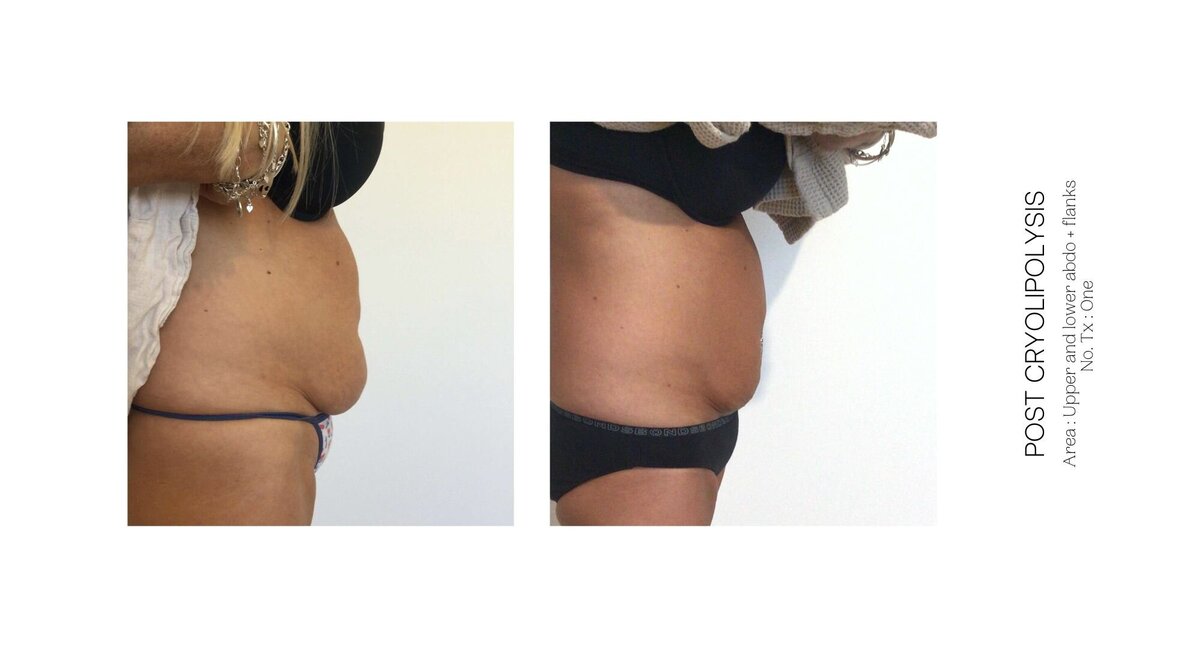 Cryolipolysis Stomach Before and After 6