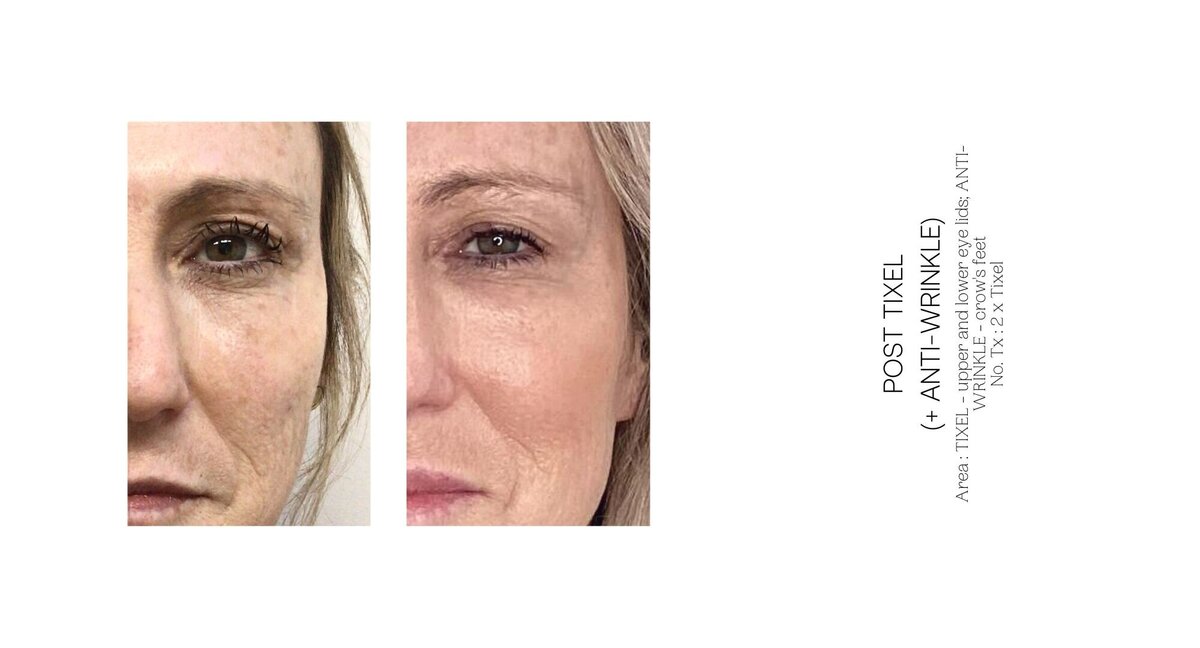 Tixel and Anti-Wrinkle Before and After