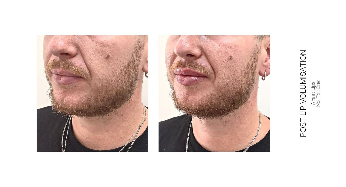 Best South Coast Lip Injection Before and After 55