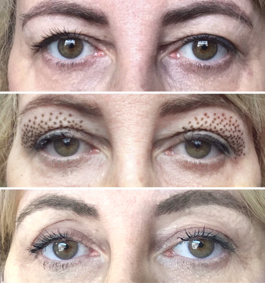 eyelidlift