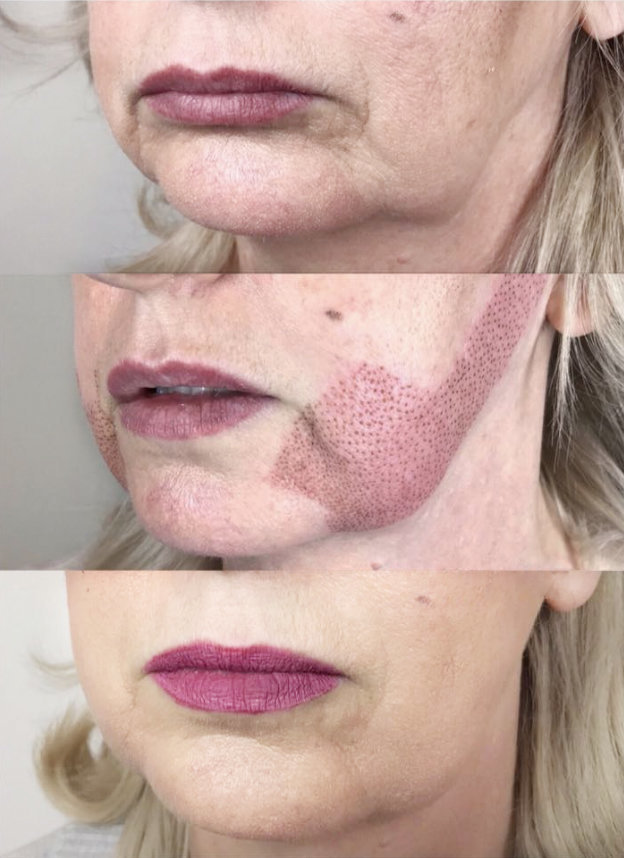 facelift