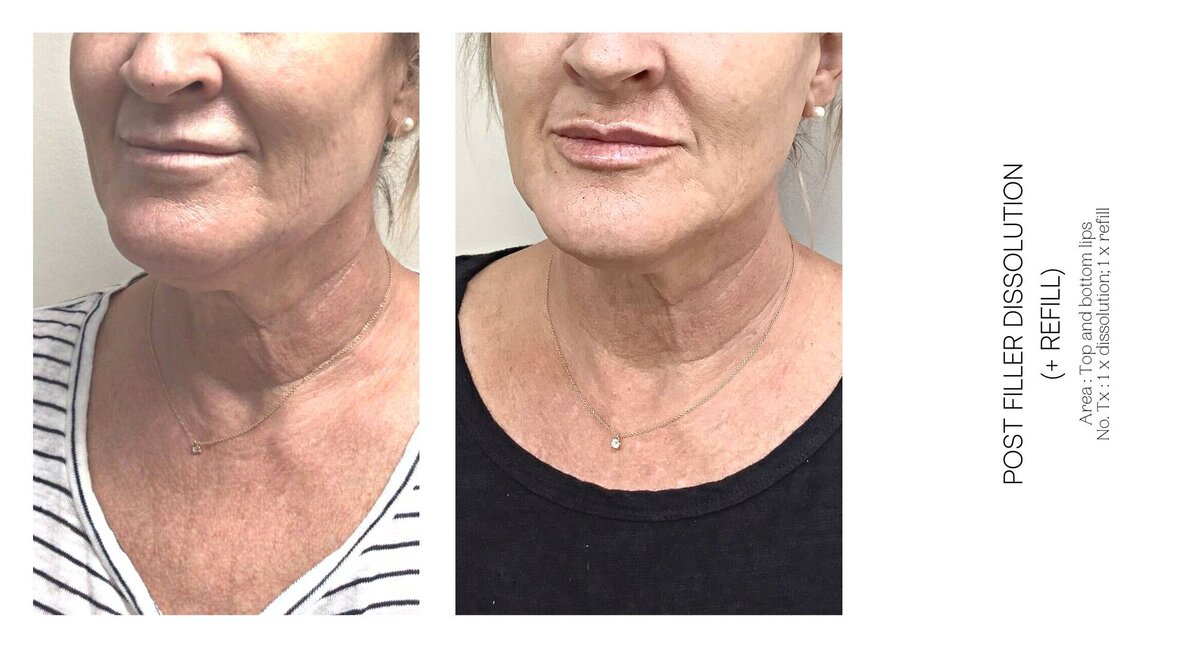 Filler Dissolve Before and After 3