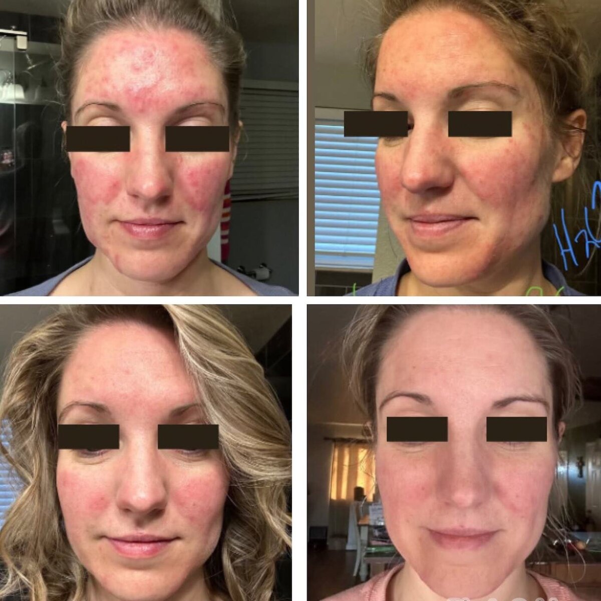 2 - Before and After Client Transformation Images 2024 - The Rosacea Method - Dr Tara Odesky 