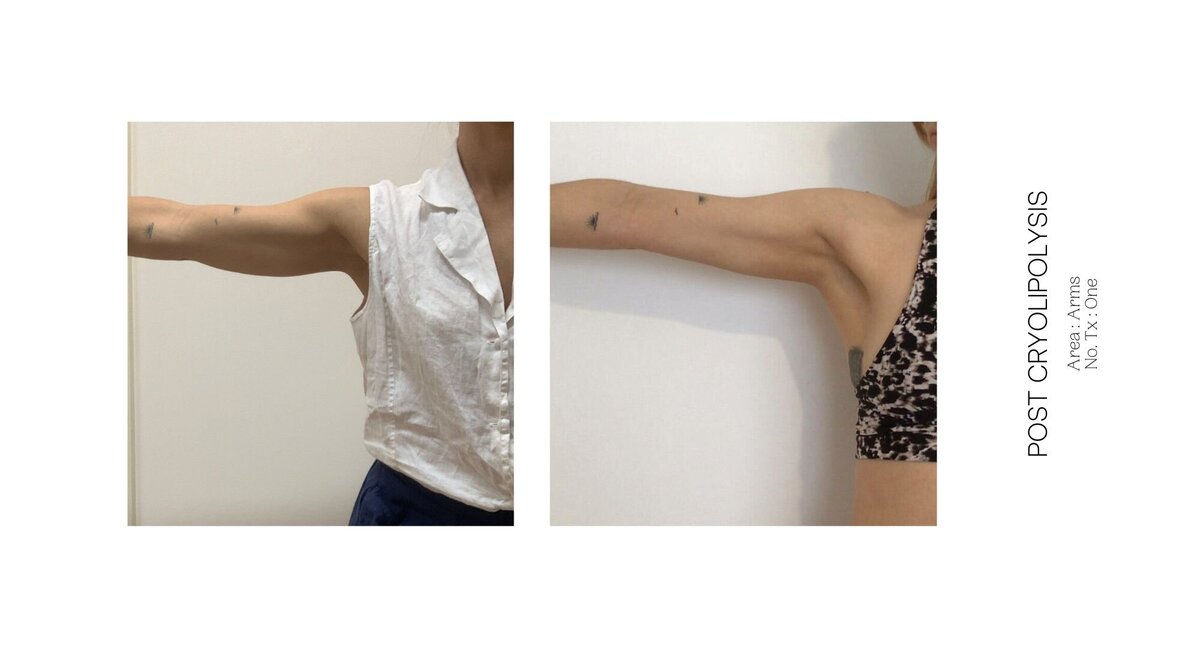 Cryolipolysis Arms Before and After 1