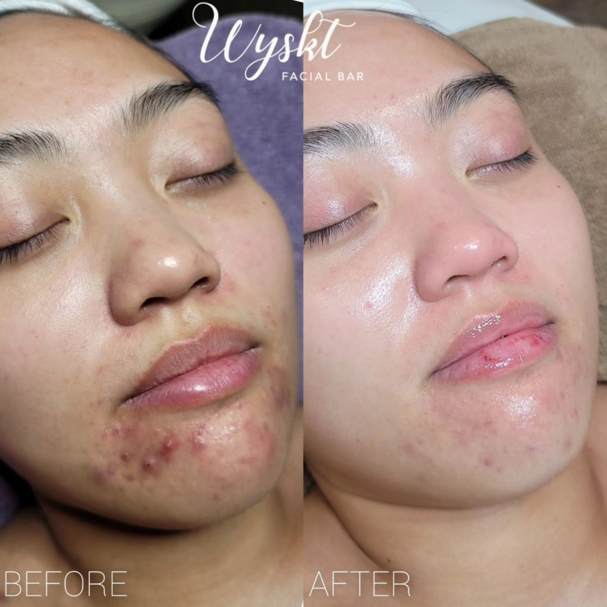 wyskt-facial-bar-acne-clearing