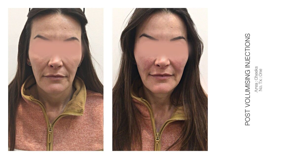 Cheek Injectable Before and After 8