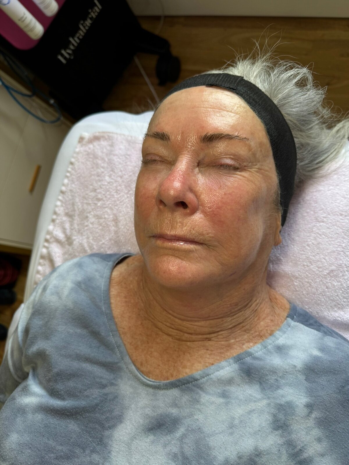 Fresh-Skin_Babes-Facial_Transformation5