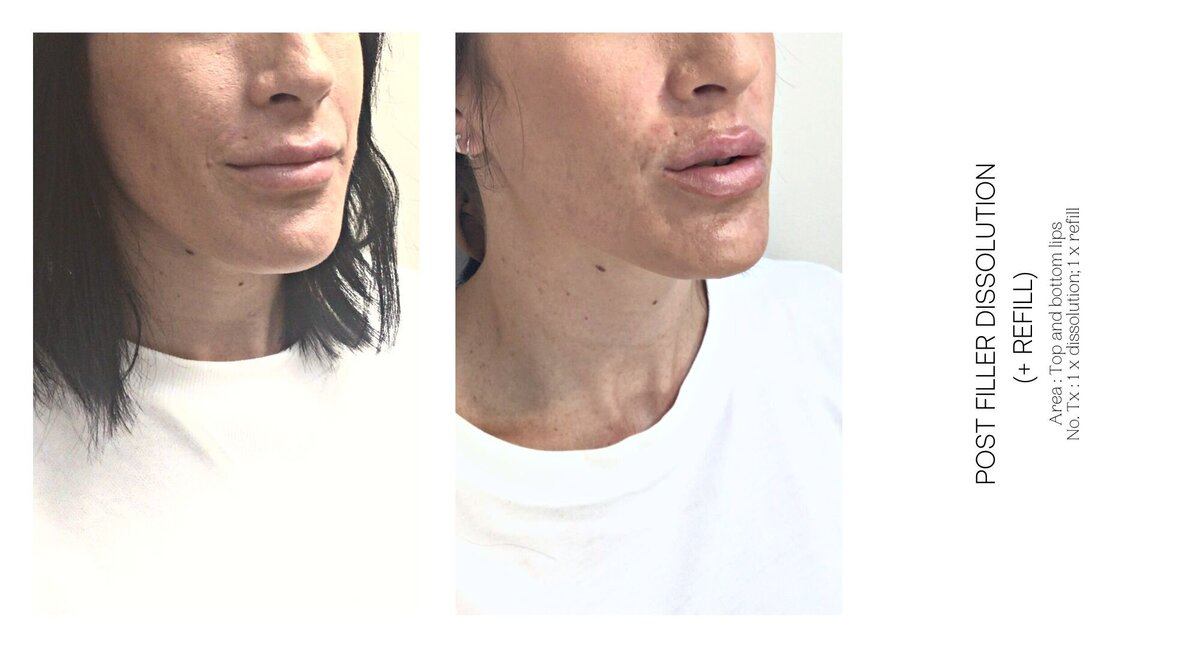 Lip Filler Dissolve Before and After 1
