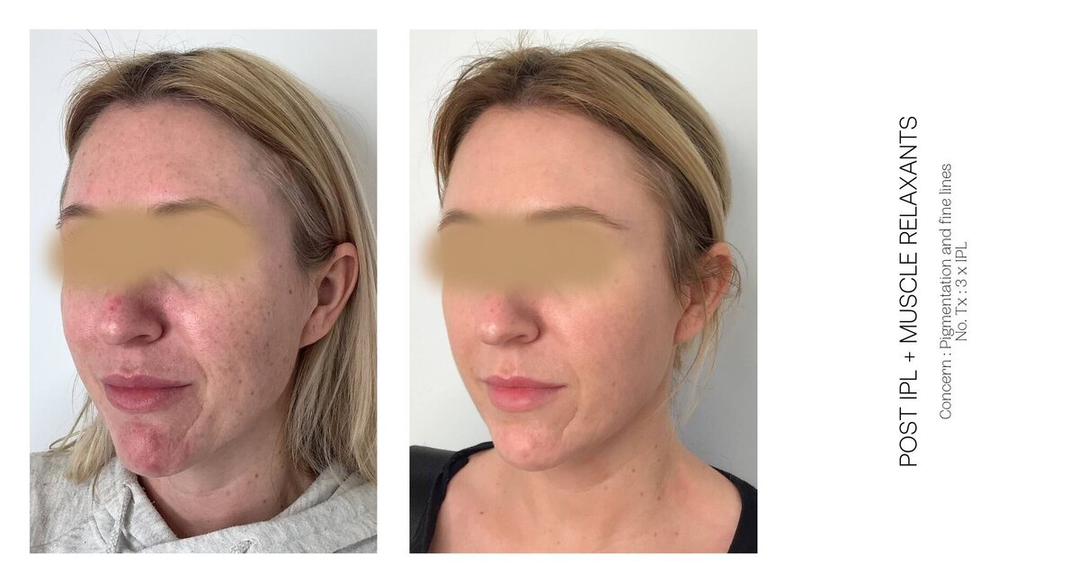 Skin Pigmentation and Fine Line Before and After 2