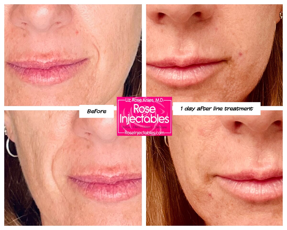 Results from a single laugh line treatment done at Rose Injectables