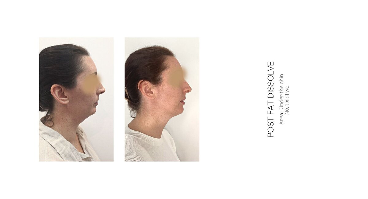 Under Chin Fat Dissolve Before and After 9