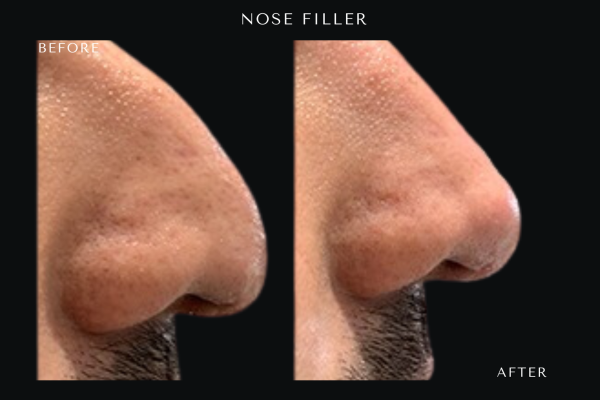 nose filler(1)