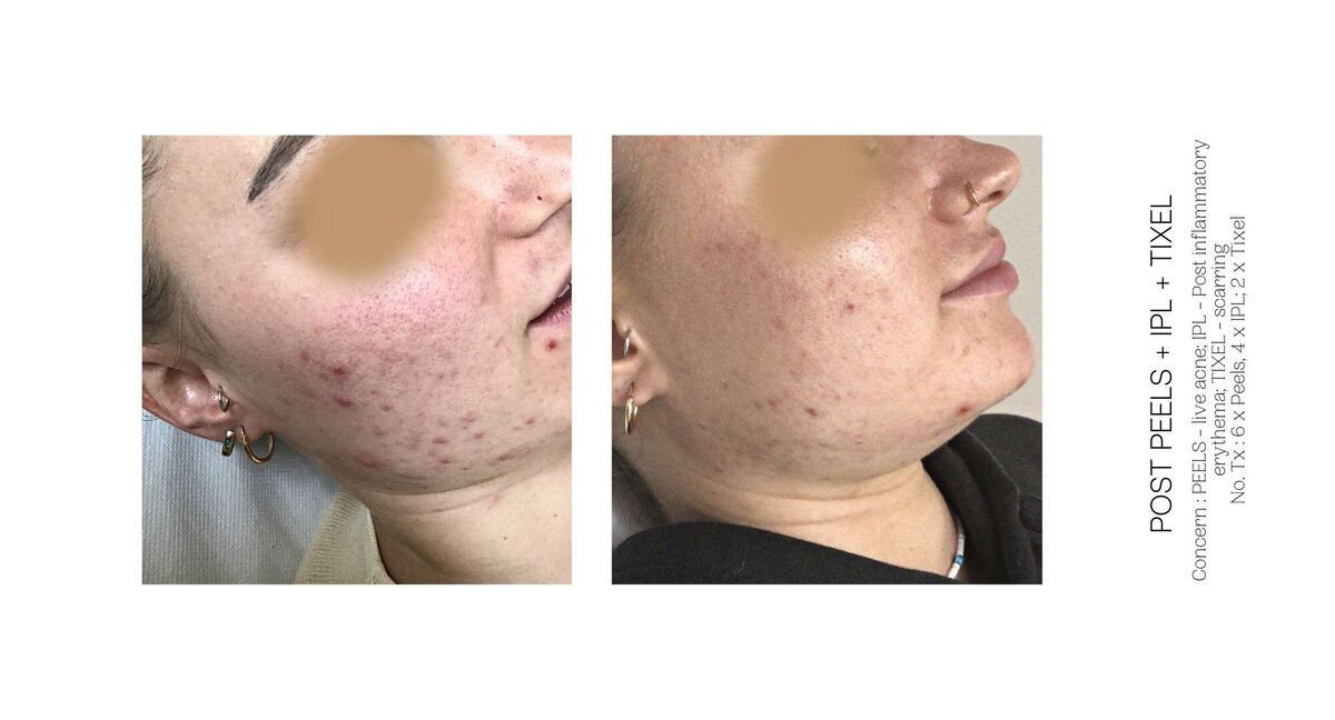 Acne Scarring Before and After 5