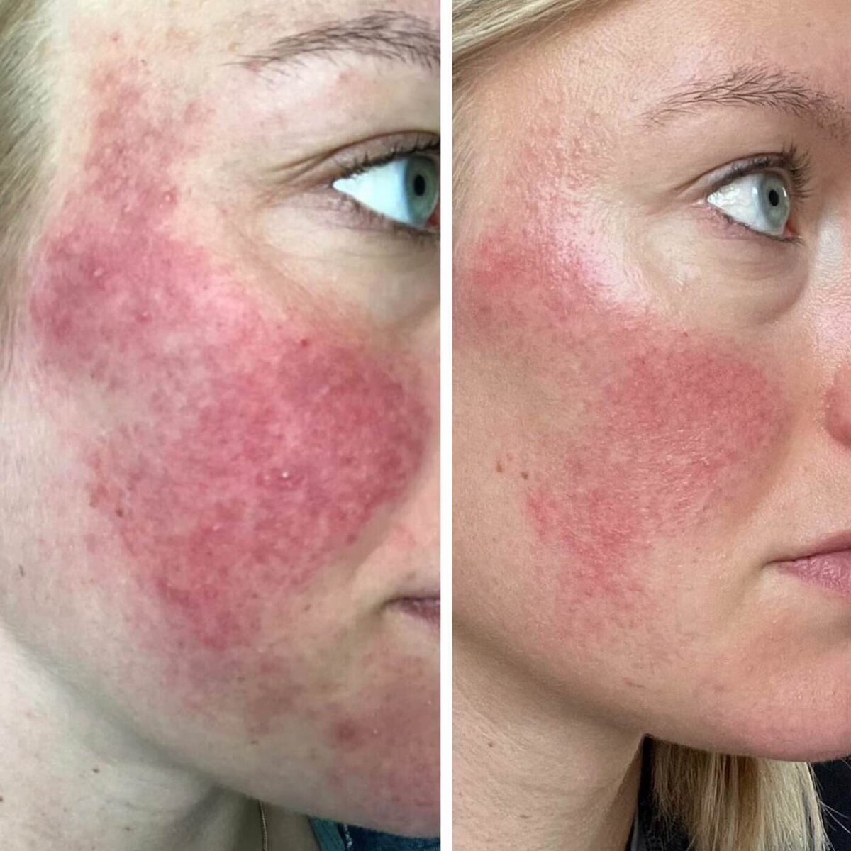 9 - Before and After Client Transformation Images 2024 - The Rosacea Method - Dr Tara Odesky 