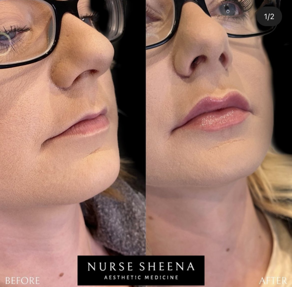 Lip Filler Results 8  by Nurse Sheena