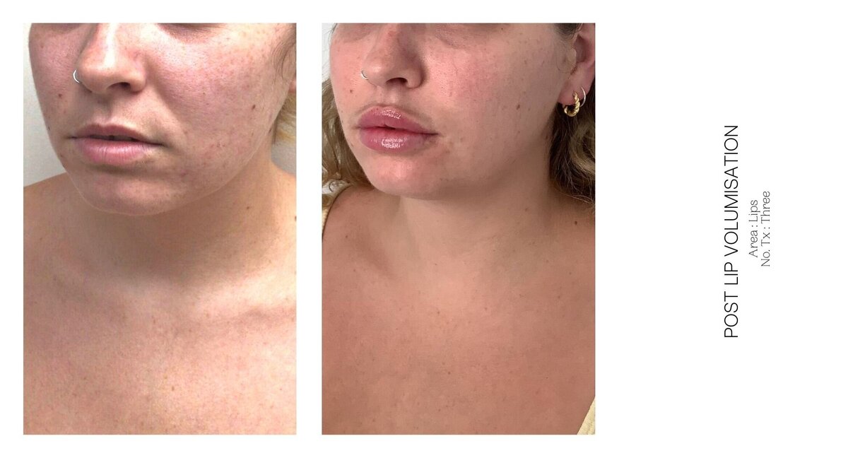 Best South Coast Lip Injection Before and After 29