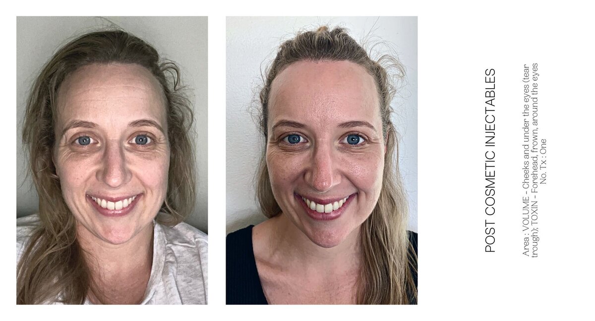 Cheek Injectable Before and After 7