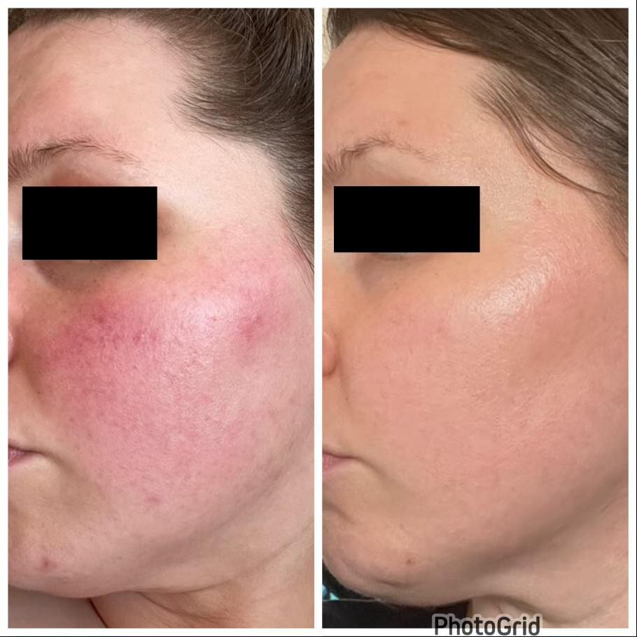 8 - Before and After Client Transformation Images 2024 - The Rosacea Method - Dr Tara Odesky 