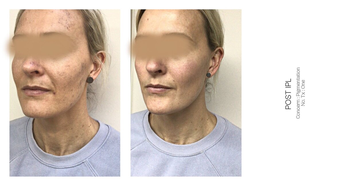 Skin Pigmentation Before and After 1
