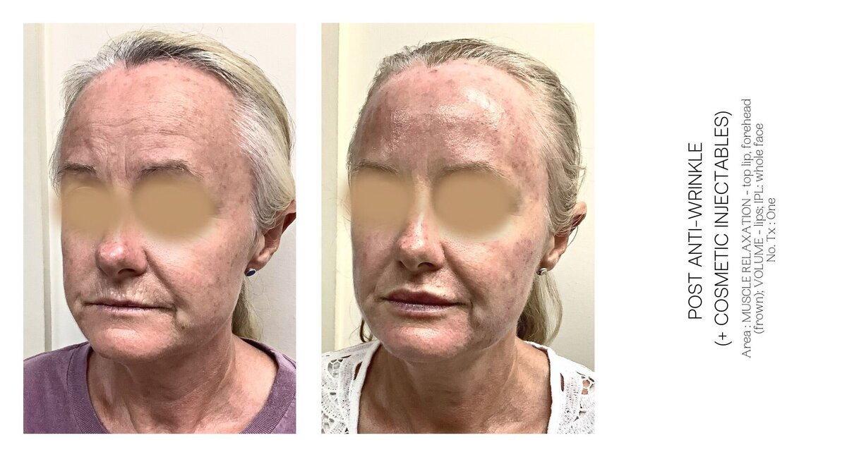 Best Anti-Wrinkle Before and After 1