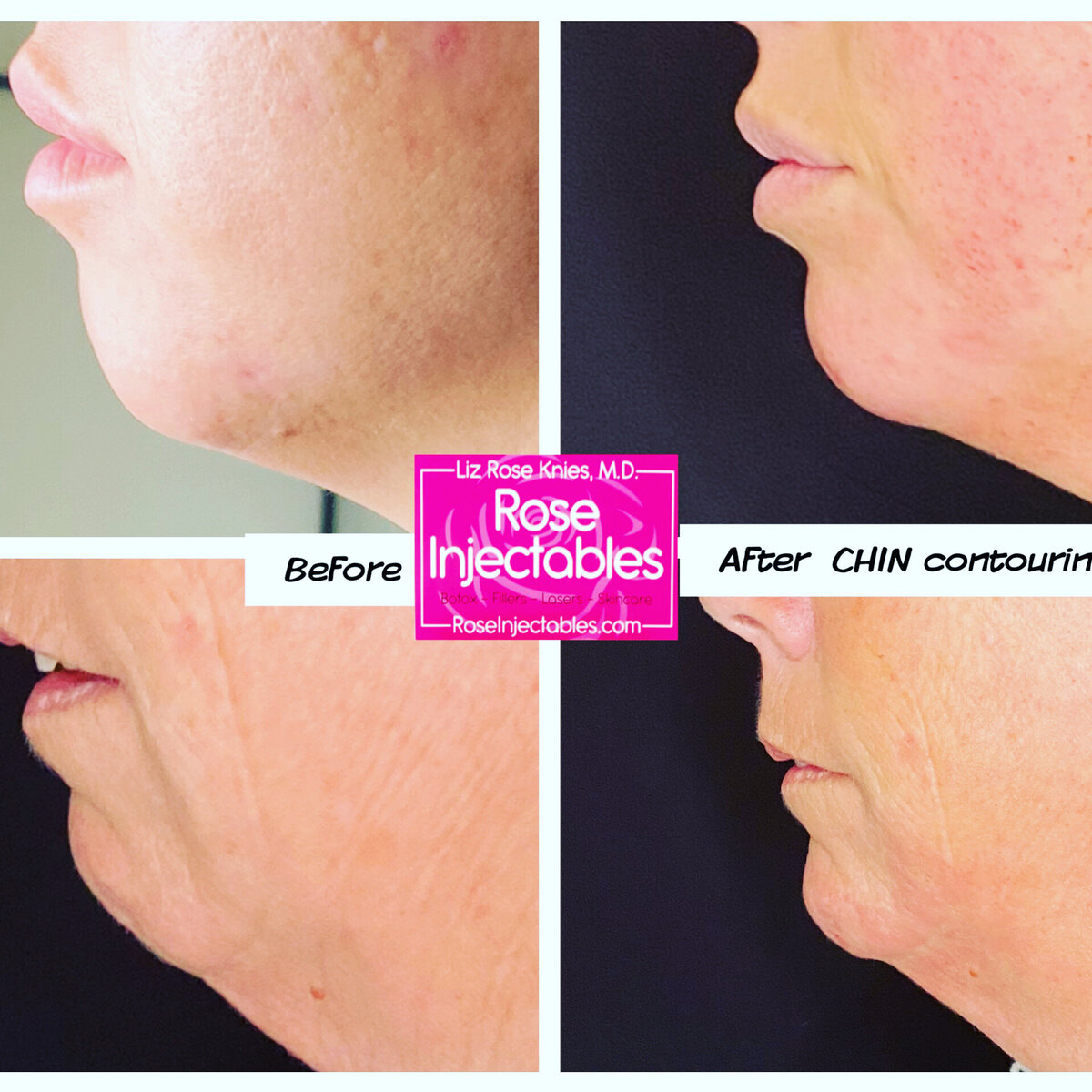 Before and after photo of a minimally invasive chin contouring procedure called Facetite completed by Dr. Knies in Canon City, CO