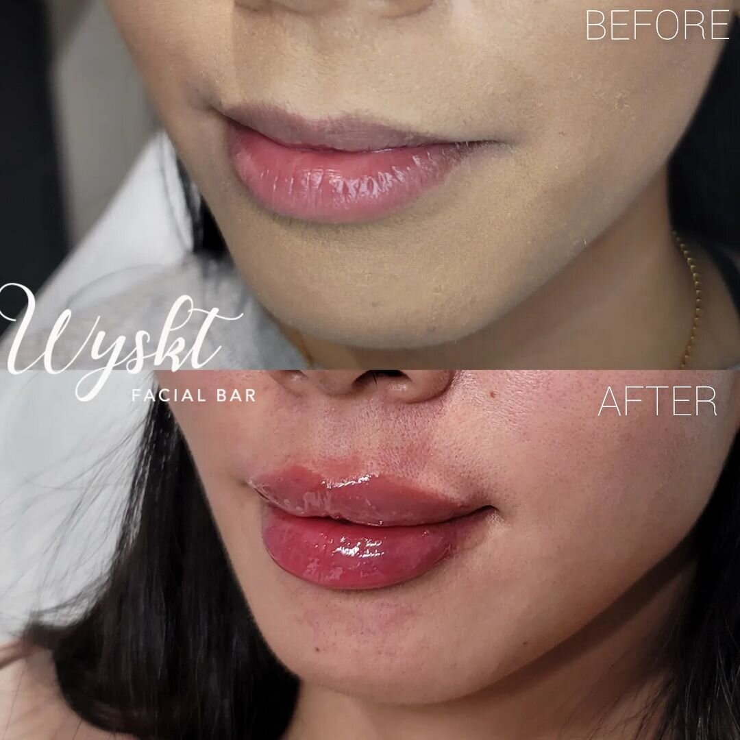 Full Lip Enhancement Results