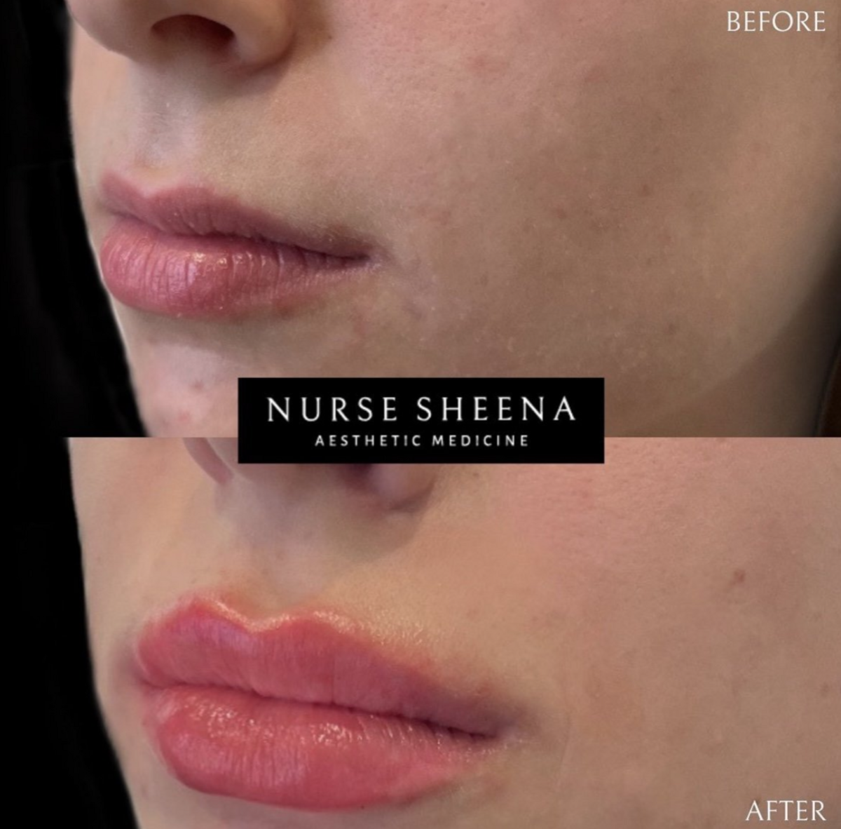 Lip Filler Results 7 by Nurse Sheena