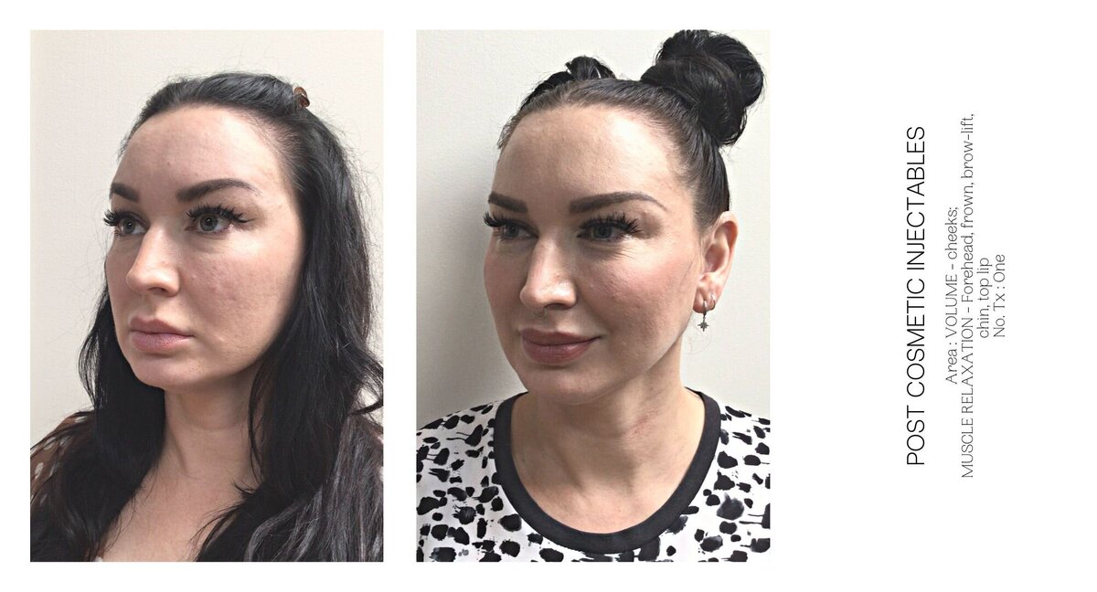 Cheek Injectable Before and After 13