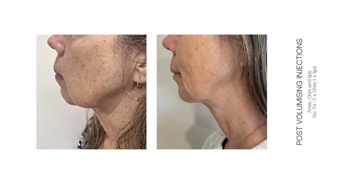 Chin Injections Before and After 4