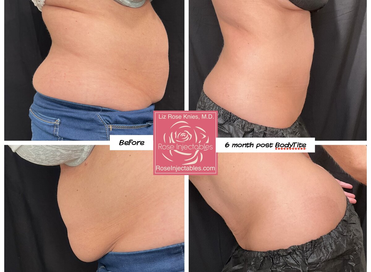 Before and after photo of a minimally invasive body contouring procedure known as Bodytite done by Dr. Knies in Canon City