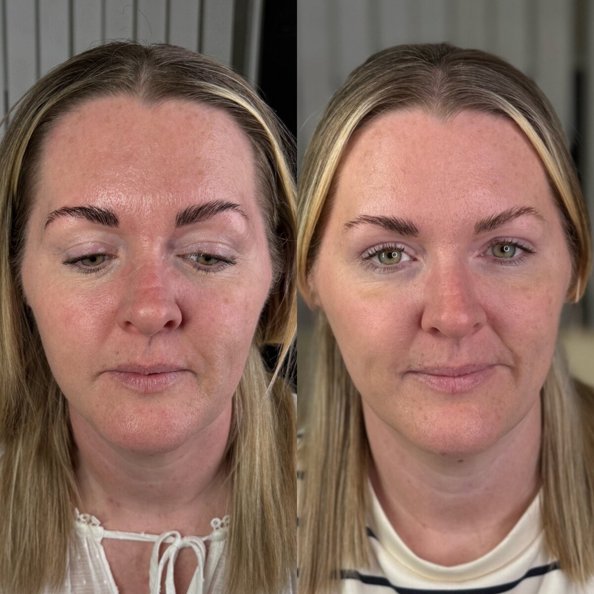 Anti-wrinkle treatment results at Alexandra Aesthetics Exeter.