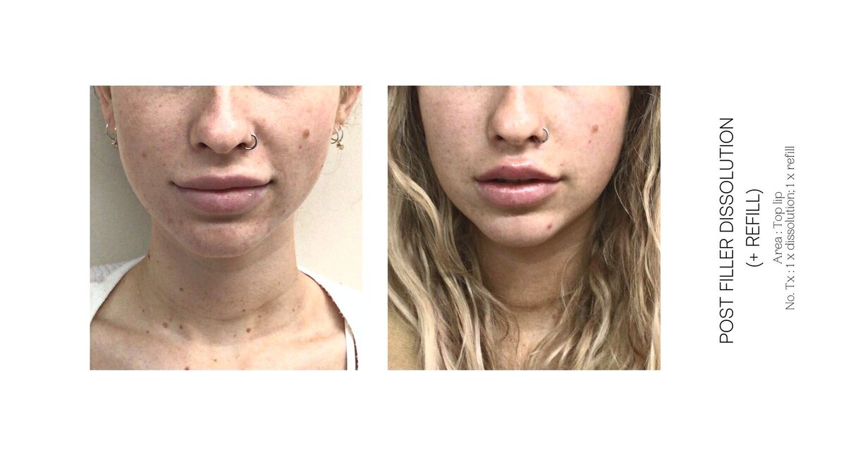 Top Lip Filler Dissolve Before and After 10