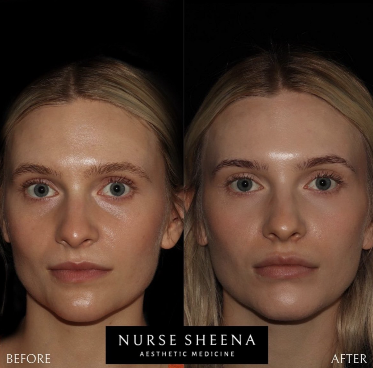 Edmonton Full Face Injections Results by Nurse Sheena