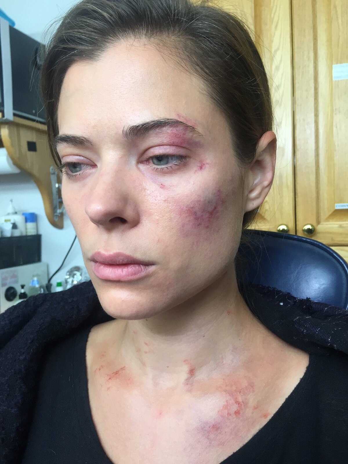 woman-fake-bruises-on-eye-cheek-film-television-makeup-fx