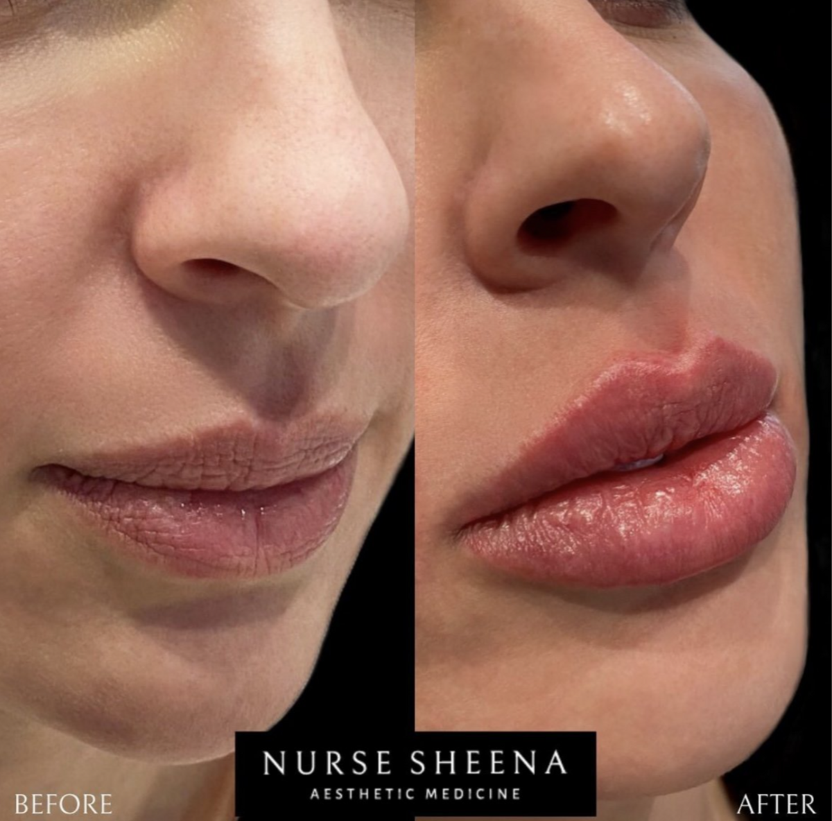 Lip Filler Results 11 by Nurse Sheena
