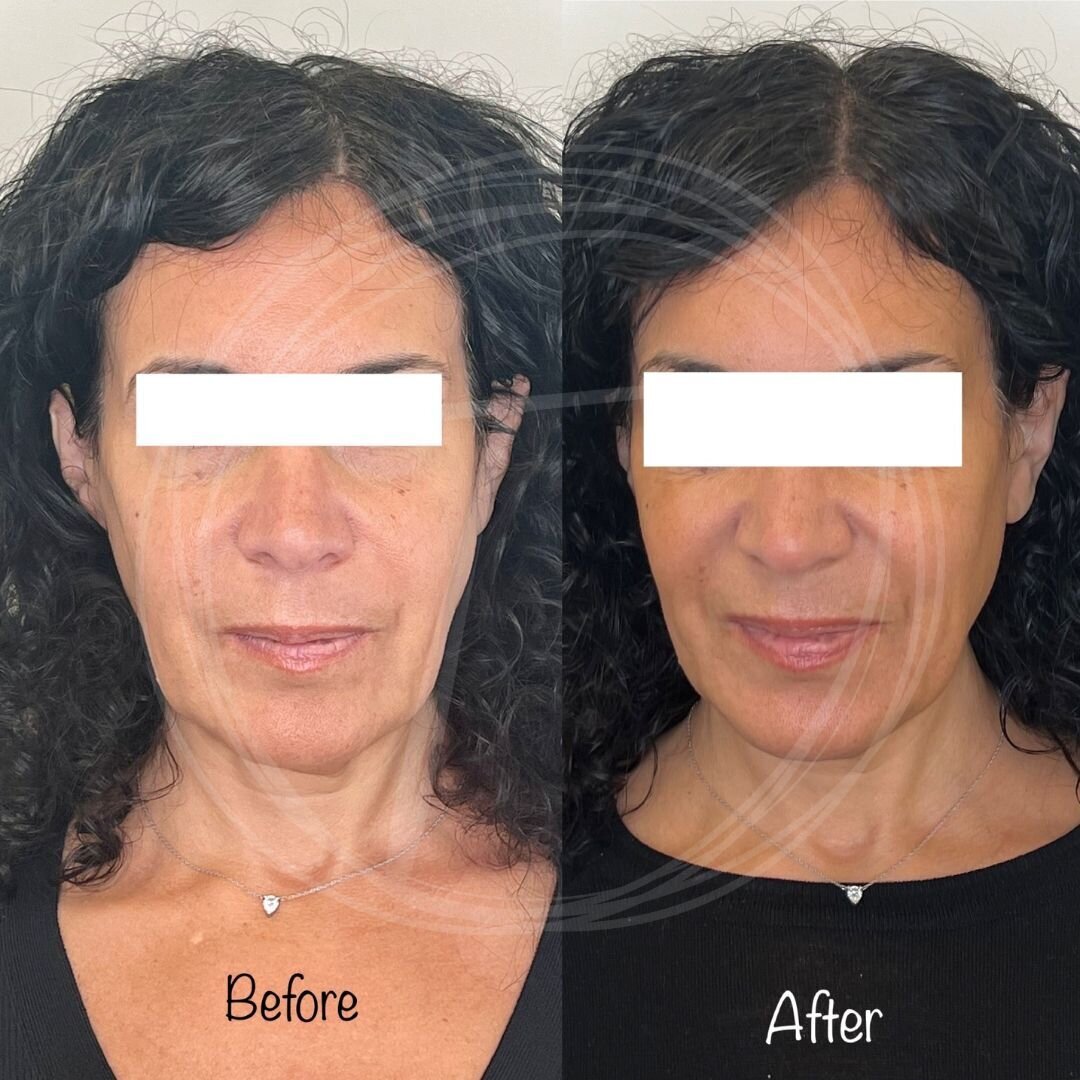 before:after results with look timeless- 7