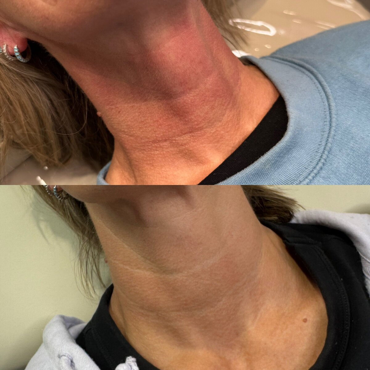 Polynucleotide treatment results at Alexandra Aesthetics.