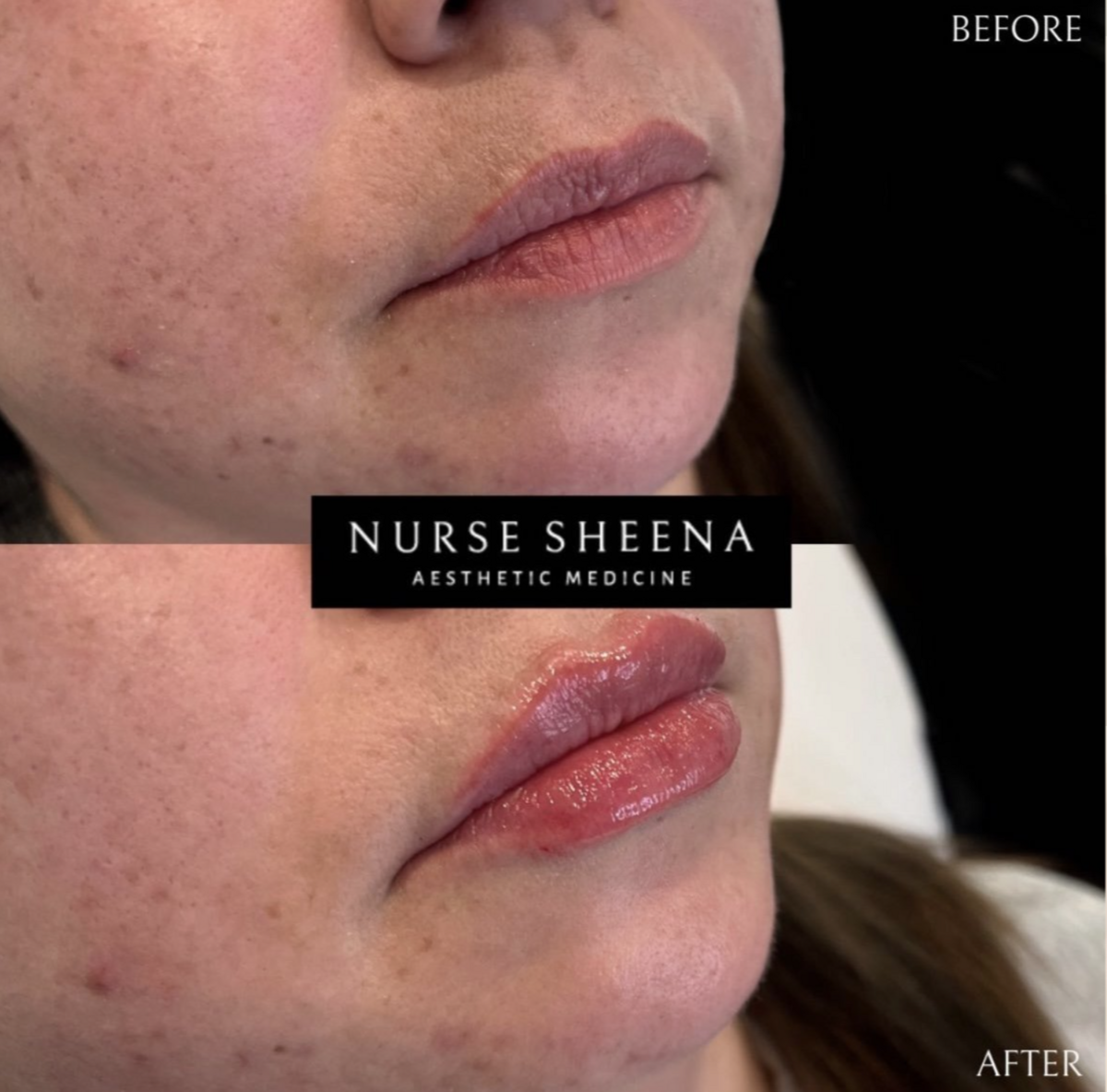 Lip Filler Results 9 by Nurse Sheena