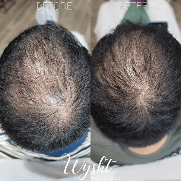 PRP Hair Restoration B&A
