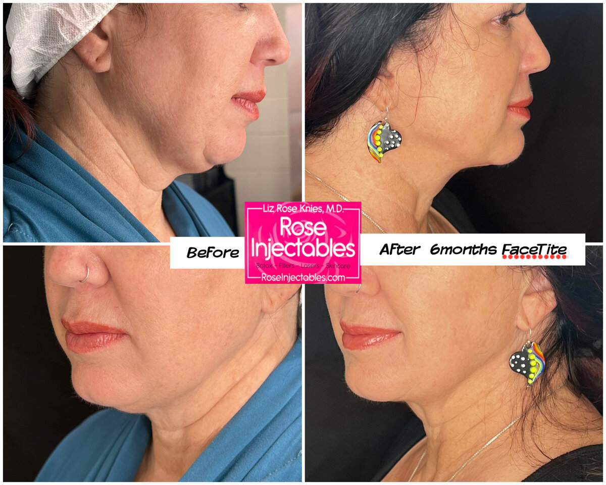 Minimally invasive facial contouring by Dr. Knies in Canon City, CO