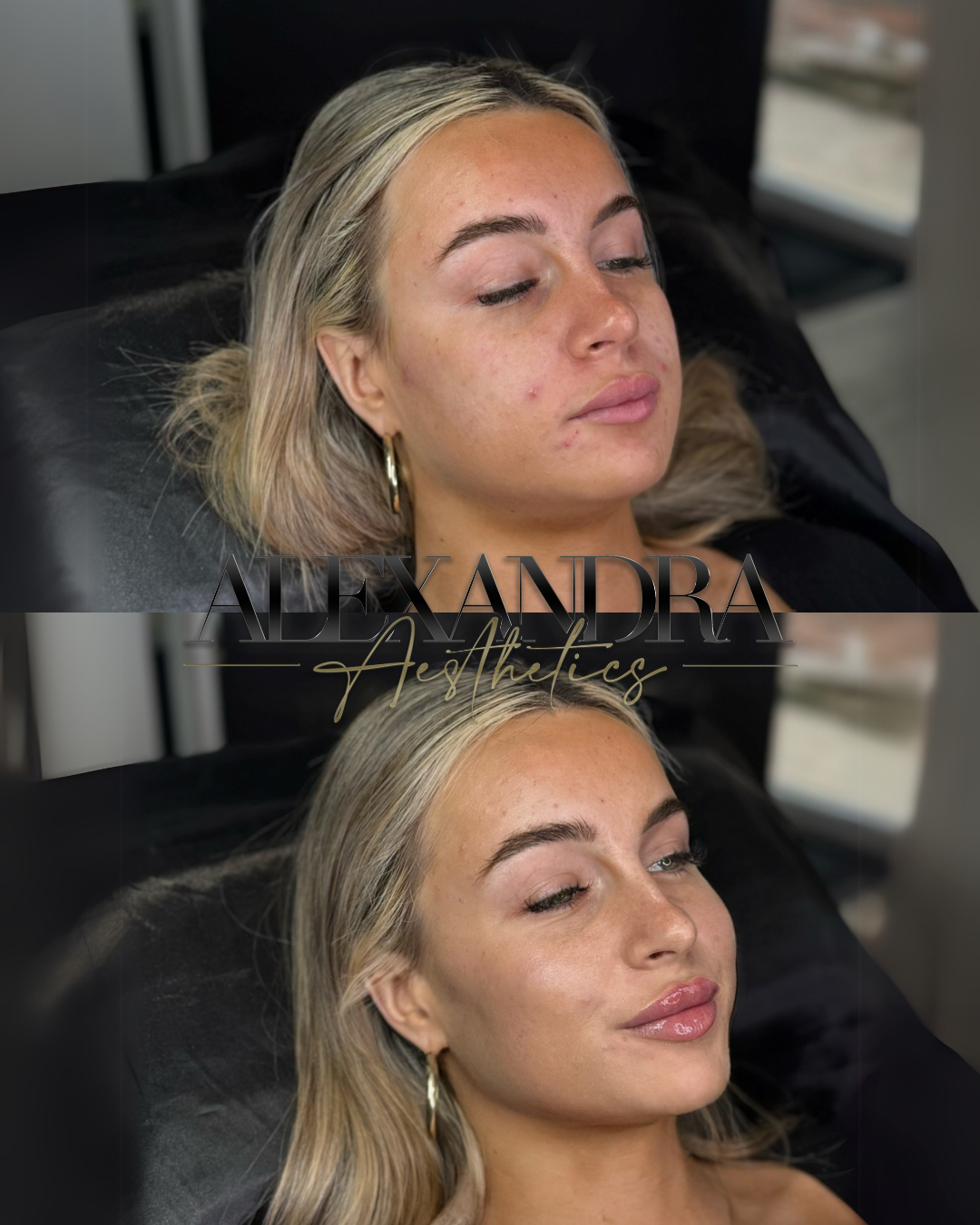 Contour Package results at Alexandra Aesthetics in Exeter