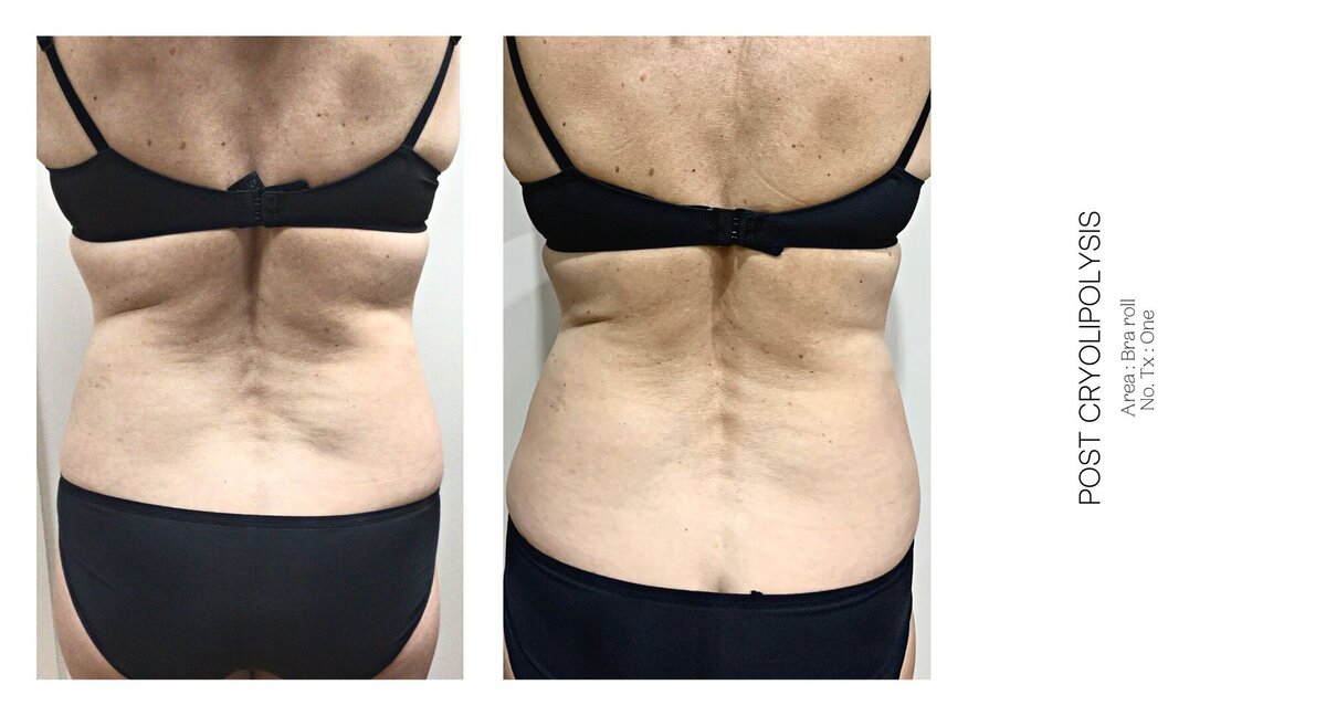 Cryolipolysis Bra Roll Before and After